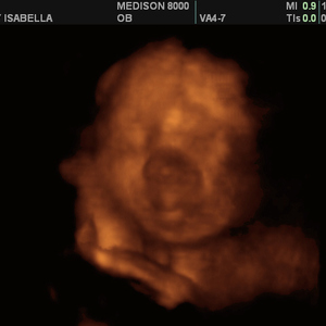 2005_Isabella_ultrasound